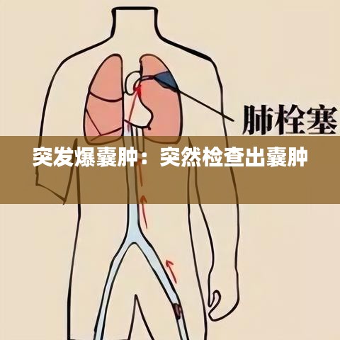 突發(fā)爆囊腫：突然檢查出囊腫 
