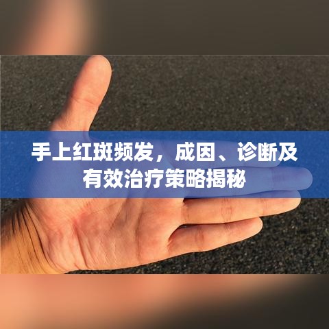 手上紅斑頻發(fā)，成因、診斷及有效治療策略揭秘