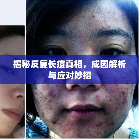 揭秘反復(fù)長(zhǎng)痘真相，成因解析與應(yīng)對(duì)妙招