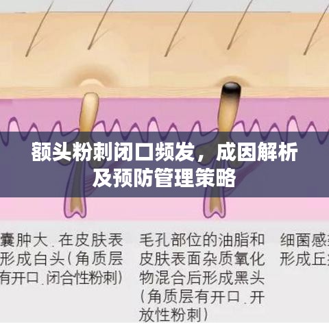 額頭粉刺閉口頻發(fā)，成因解析及預(yù)防管理策略